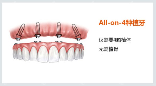 all-on-4种植牙技术的价格