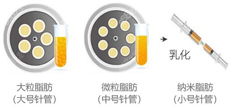 不同脂肪运用不同针管