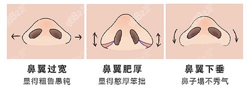鼻翼缩小的原理图