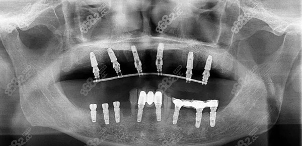 十几万全口种植牙