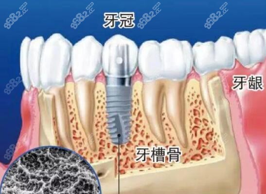种植假牙修复