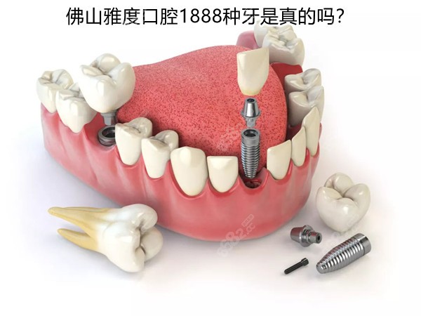 佛山雅度口腔1888种牙是真的吗？