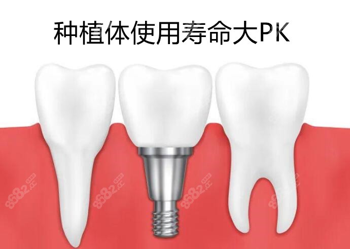 种植体使用寿命PK