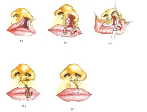 唇裂修复手术过程