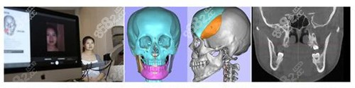 数字化3D导板