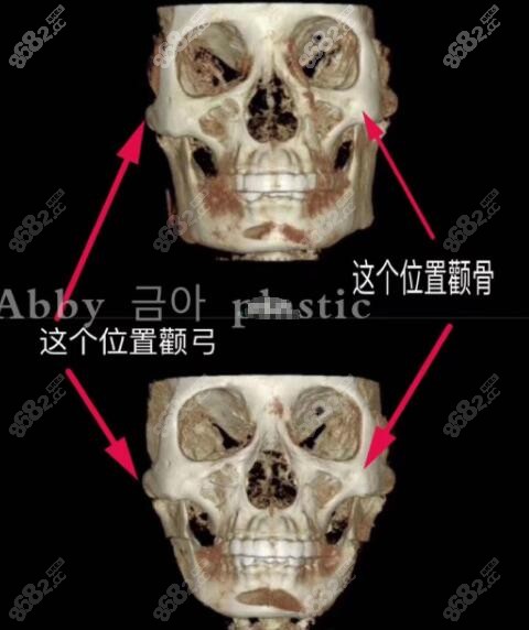 吉玫锡院长颧骨颧弓处固定方式