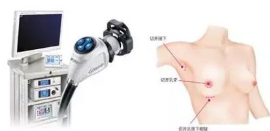 內(nèi)窺鏡假體隆胸的優(yōu)勢 內(nèi)窺鏡假體隆胸的優(yōu)勢