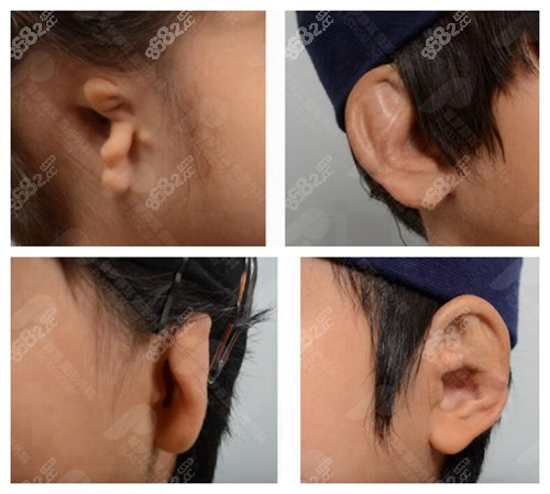 一侧耳朵天生两个耳垂图片