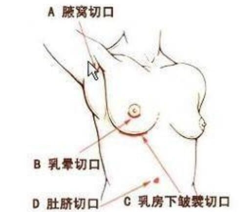 假體隆胸的切口位置 假體隆胸的切口位置