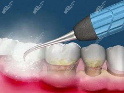 牙齿健康洗牙