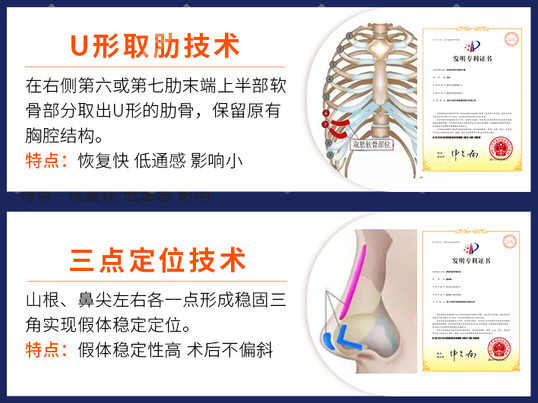 贵阳美贝尔徐威隆鼻技术