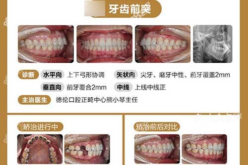 广州德伦口腔医院舌侧矫正反馈图