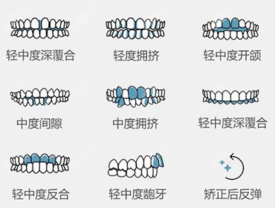 哪些牙齿需要进行正畸改善