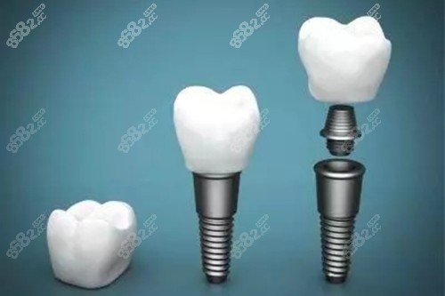 种植牙操作示意图 种植牙操作示意图