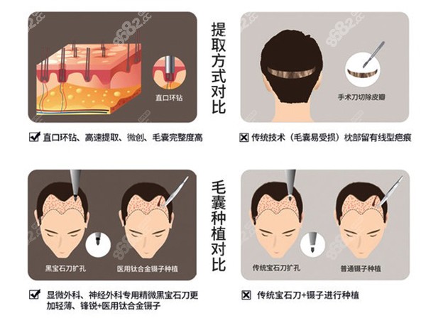 FUE无痕植发技术过程