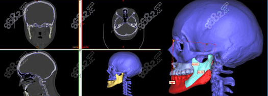 广东美恩的凸嘴矫正3D正颌手术利用了3D导板技术