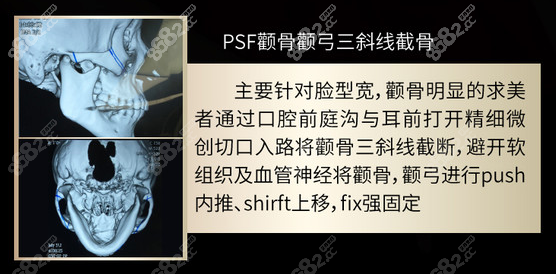 PSF颧骨颧弓三斜线截骨术图示