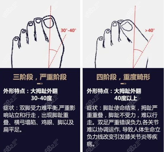 <!--<i data=20240705-sp></i>-->做大脚骨矫正真的很神奇