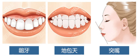 广东美恩的3D正颌手术适应症