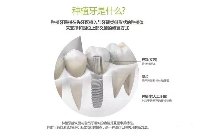 先来了解一下种植牙是什么