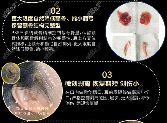 <!--<i data=20240705-sp></i>-->付国友颧骨改脸型的优势