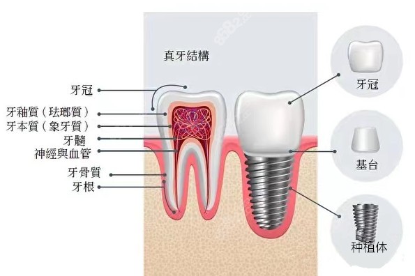 了解一下种植牙的构造吧