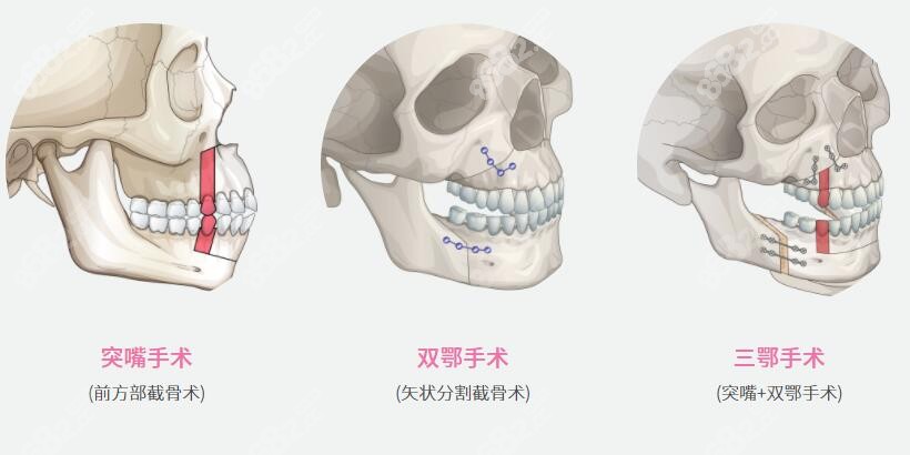 正颌手术的三种分类