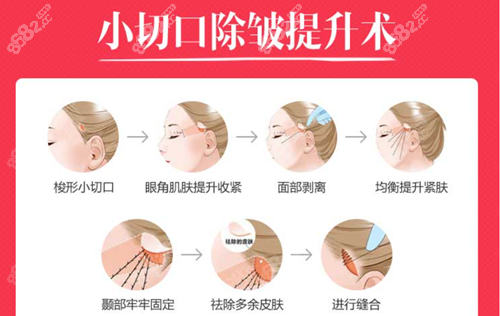 小切口拉皮除皱术的操作流程