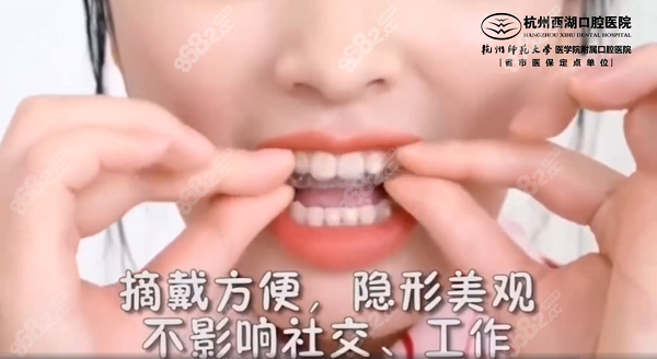 杭州西湖口腔医院隐形矫正