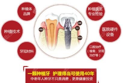 国产种植牙品牌大全及价格推送