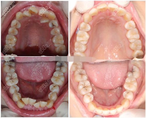 上海松丰口腔牙齿矫正对比照