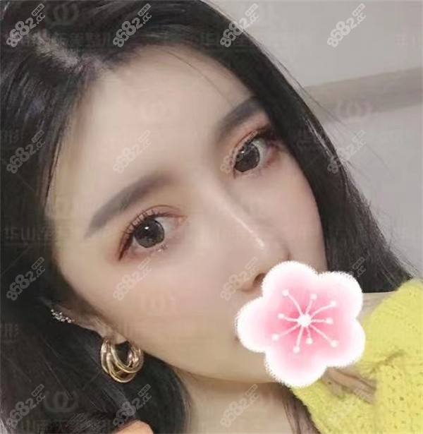 杭州连天美：美眼美鼻真是实例分享