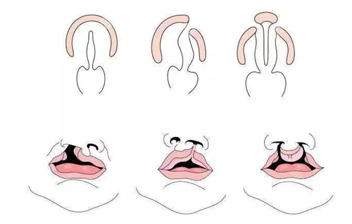 唇裂的几种类型