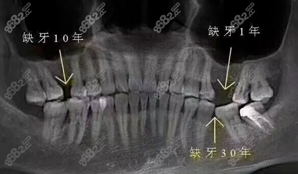 维乐口腔种植牙