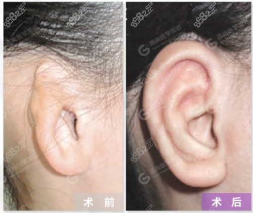 广州高尚余文林耳朵畸形整形前后对比照