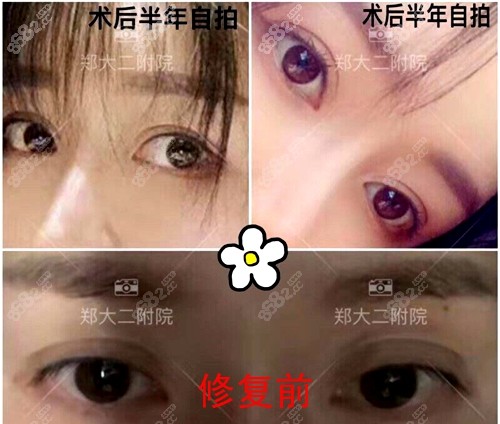郑州大学第二附属医院刘月丽医生双眼皮修复术前术后对比图