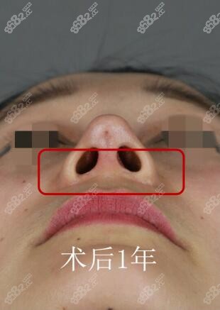 上海联合丽格鼻翼缩小术后一年无疤痕