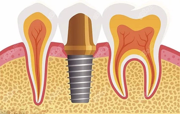 牙齿种植的收费标准参考