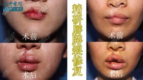 广州中家医家庭医生黄广香唇腭裂前后对比照