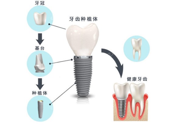 种植牙的组成个构造了解一下