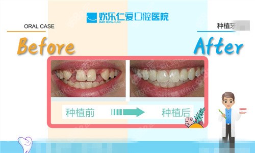 沈阳欢乐仁爱口腔种植牙