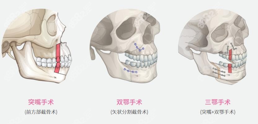 地包天手术中的三种分类