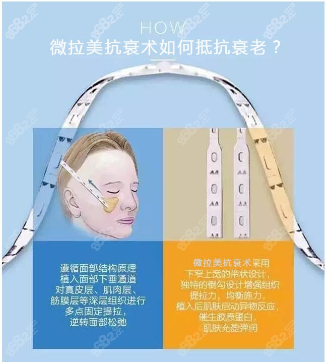 微拉美是什么拉皮抗衰技术