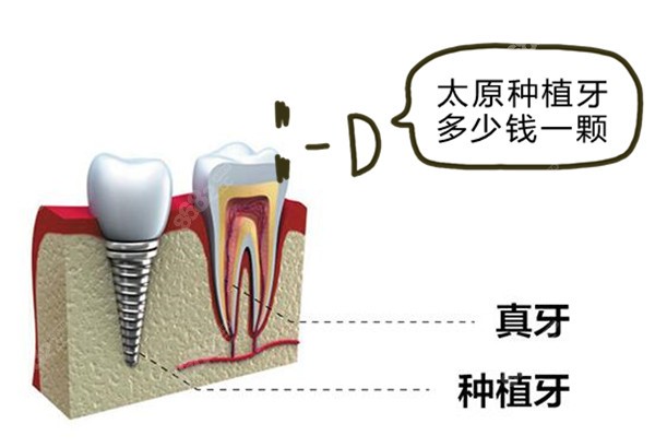 山西太原种植牙费用大概是多少钱一颗