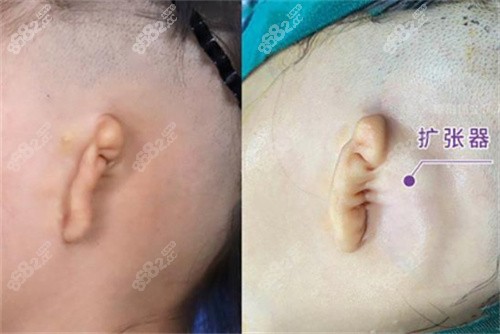 先天性耳朵畸形治疗