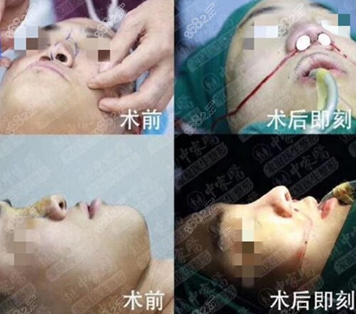 广州中家医家庭医生黄广香唇腭裂术前术后对比