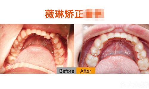 宁波薇琳口腔医院牙齿矫正
