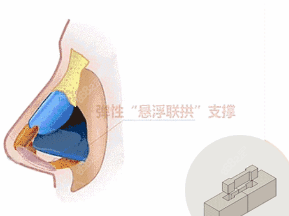 假体和耳软骨连接优势