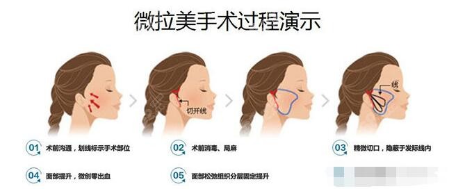 医生微拉美手术示意图