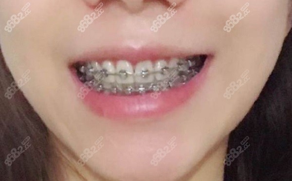 重庆牙卫士口腔医院牙齿矫正